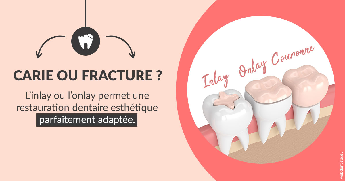 https://dr-benjamin-lascar.chirurgiens-dentistes.fr/T2 2023 - Carie ou fracture 2