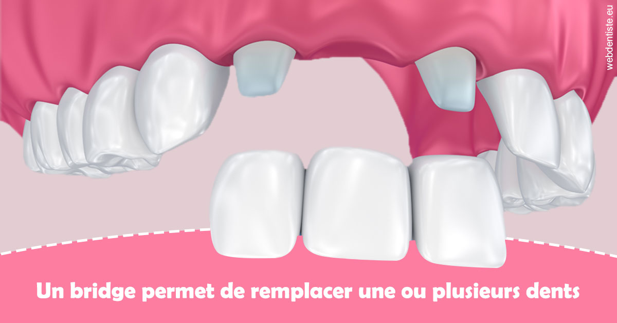 https://dr-benjamin-lascar.chirurgiens-dentistes.fr/Bridge remplacer dents 2