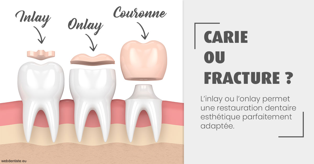 https://dr-benjamin-lascar.chirurgiens-dentistes.fr/T2 2023 - Carie ou fracture 1